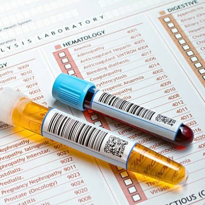 "Two tubes labeled with bar codes, each urine sample and one with blood on a medical report for a routine analysis"