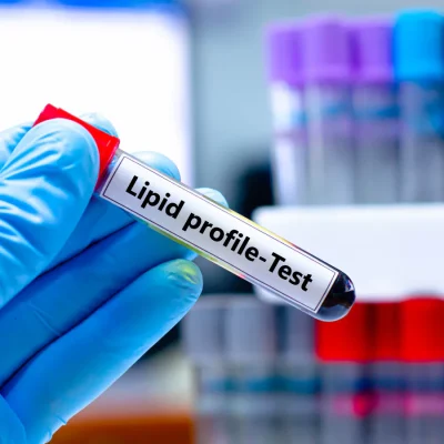 lipid-profile-test-2024-07-41f454af10f84bd238502c21a1077dd9
