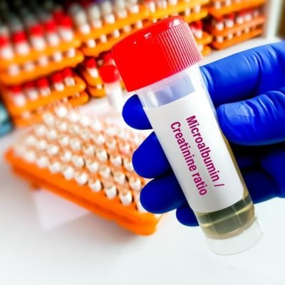 urine-sample-urine-acr-microalbumin-creatinine-ratio_595440-1454